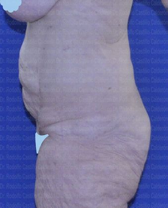 Post Bariatric Plastic Surgery: Belt Lipectomy after losing 160 lbs - before belt Lipectomy lateral view