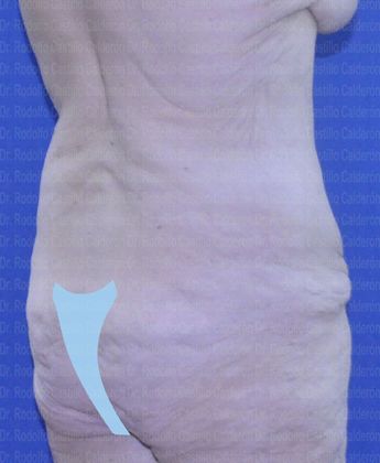 Post Bariatric Plastic Surgery: Belt Lipectomy after losing 160 lbs - Before Belt Lipectomy posterior oblique view