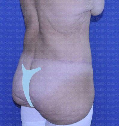 Post Bariatric Plastic Surgery: Belt Lipectomy after losing 160 lbs - After Belt lipectomy posterior oblique view