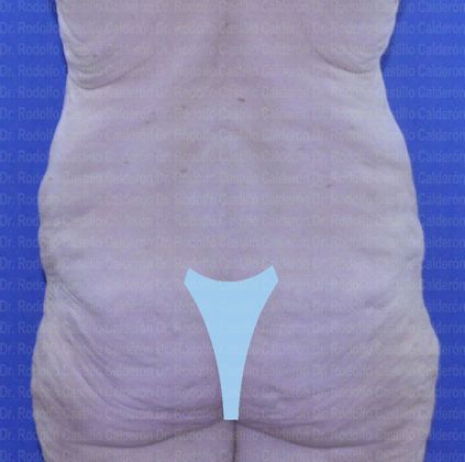Post Bariatric Plastic Surgery: Belt Lipectomy after losing 160 lbs - Before Belt lipectomy posterior view