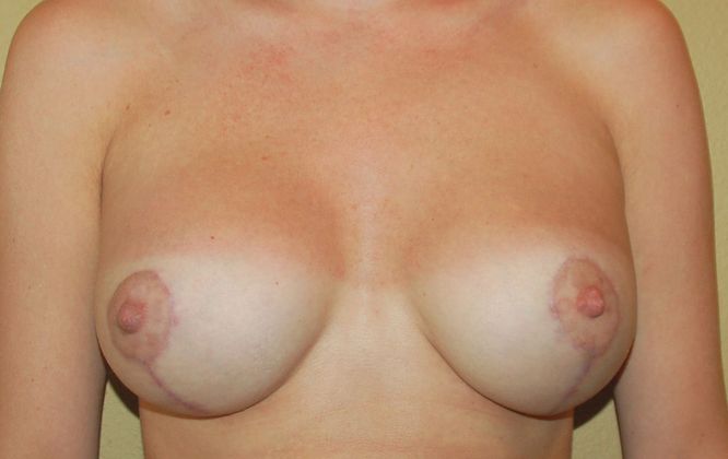 Breast Augmentation w/ Lift Case 75 - After