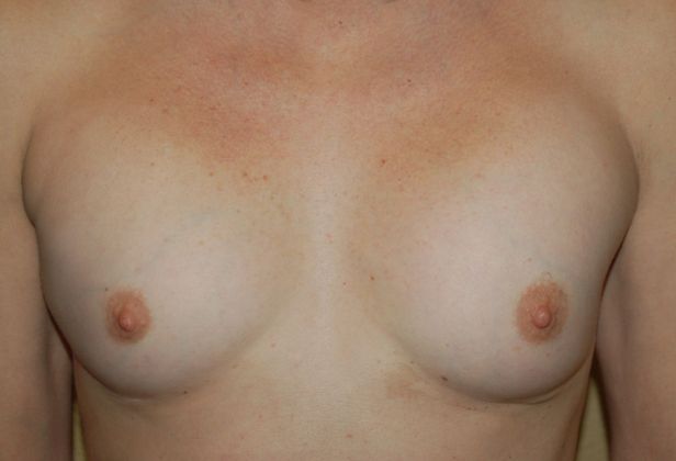 Breast Revision: Case 20 - Before