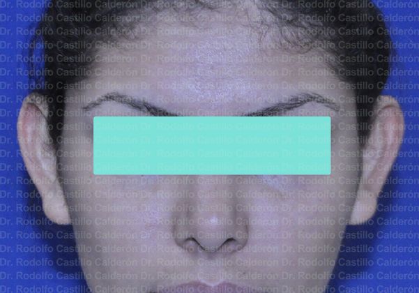 Otoplasty Otoplasty in woman - Before