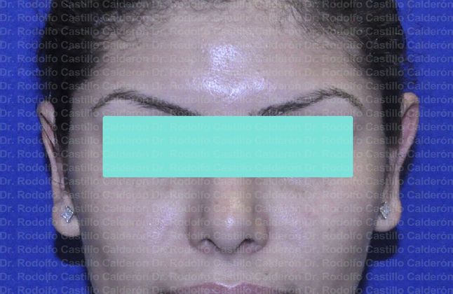 Otoplasty Otoplasty in woman - After