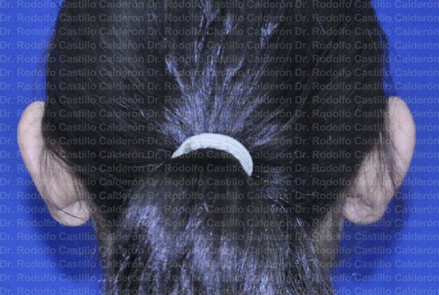 Otoplasty: Otoplasty in woman - Before Otoplasty Posterior view