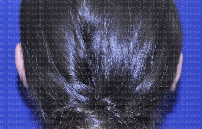 Otoplasty: Otoplasty in woman - After Otoplasty Posterior view