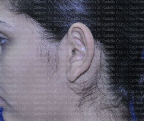 Otoplasty: Otoplasty in woman - Before otoplasty lateral view