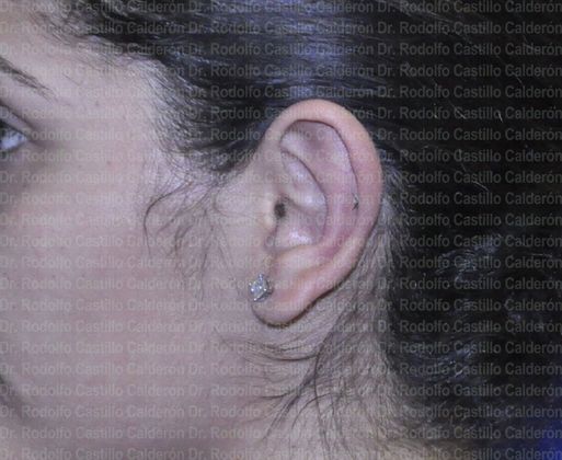 Otoplasty: Otoplasty in woman - After otoplasty lateral view