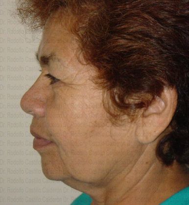 Face & Neck Lifts: Face lift, neck lift and Blepharoplasty - Before facelift, neck lift and blepharoplasty lateral view