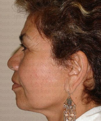 Face & Neck Lifts: Face lift, neck lift and Blepharoplasty - After facelift, neck lift and blepharoplasty lateral view