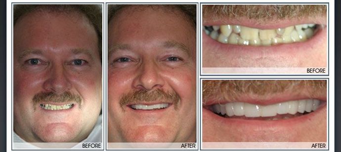 Smile Makeover Case 9
