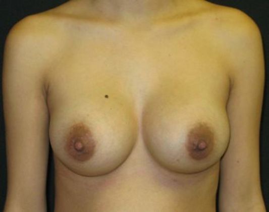Breast Augmentation: Case 5 - After 18 months