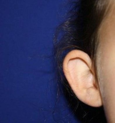 Ear Surgery - Otoplasty: Case 1 - Before