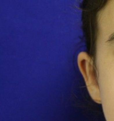 Ear Surgery - Otoplasty: Case 1 - After