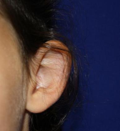 Ear Surgery - Otoplasty: Case 1