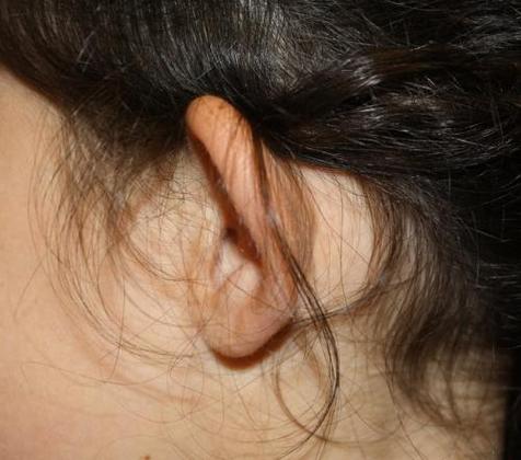 Ear Surgery - Otoplasty: Case 1