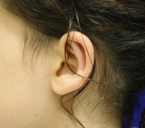 Ear Surgery - Otoplasty: Case 1