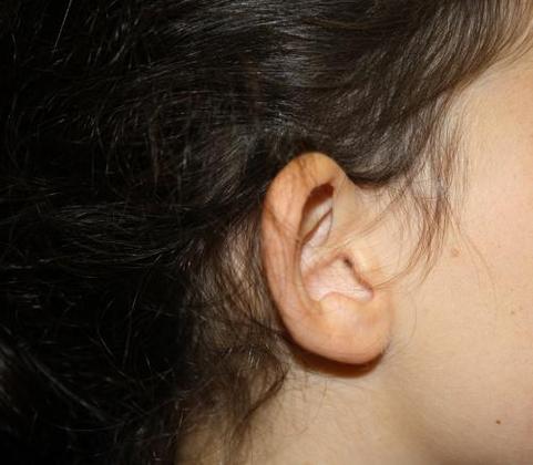 Ear Surgery - Otoplasty: Case 1