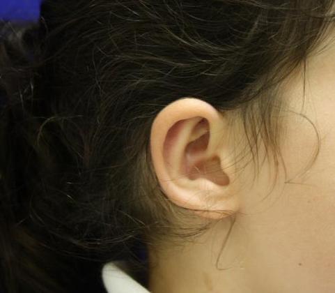 Ear Surgery - Otoplasty: Case 1