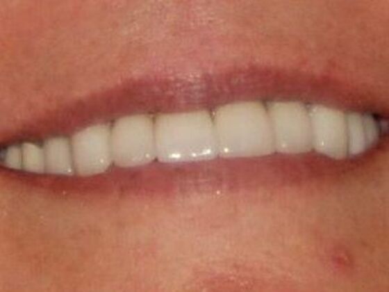 Smile Design: Case 1 - After