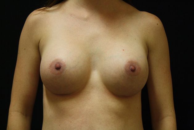 Breast Augmentation: Case 3