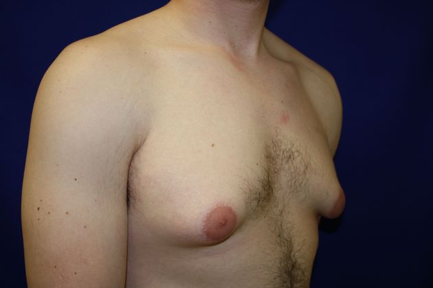 Gynecomastia: Case 1