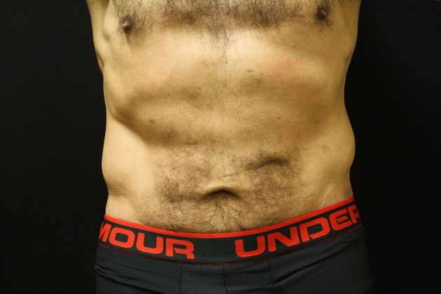 Body Lift Case 6 - After