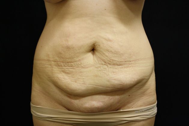 Revision Tummy Tuck  Dr. Sands New Orleans