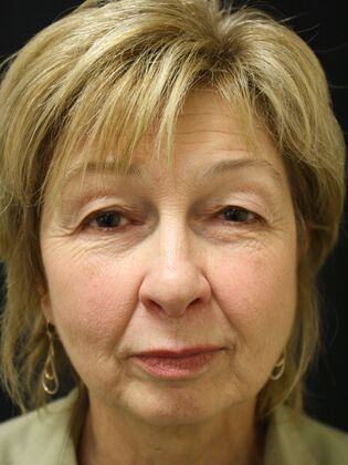 Face & Neck Lifts Case 19 - Before