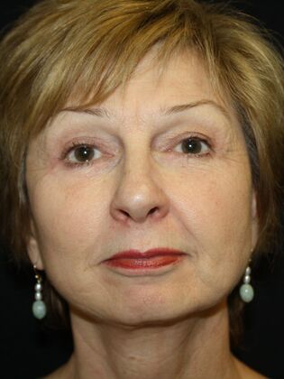 Face & Neck Lifts Case 19 - After