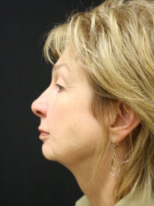 Face & Neck Lifts: Case 19