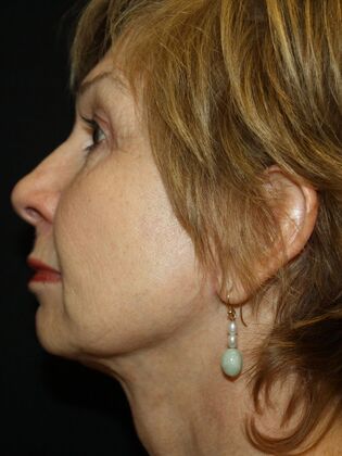 Face & Neck Lifts: Case 19
