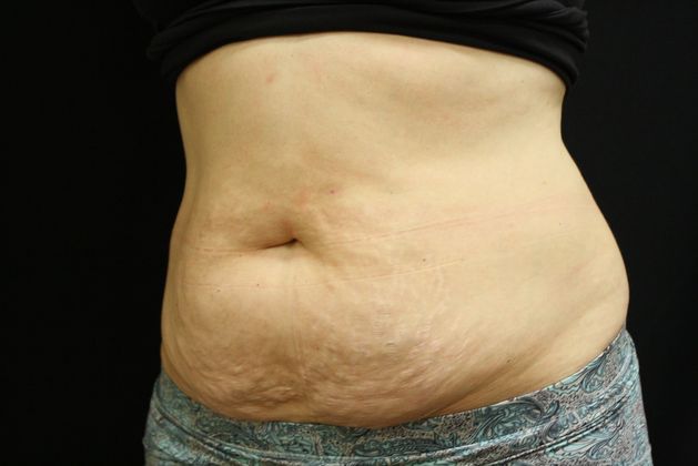 Tummy Tuck: Case 6 - Before