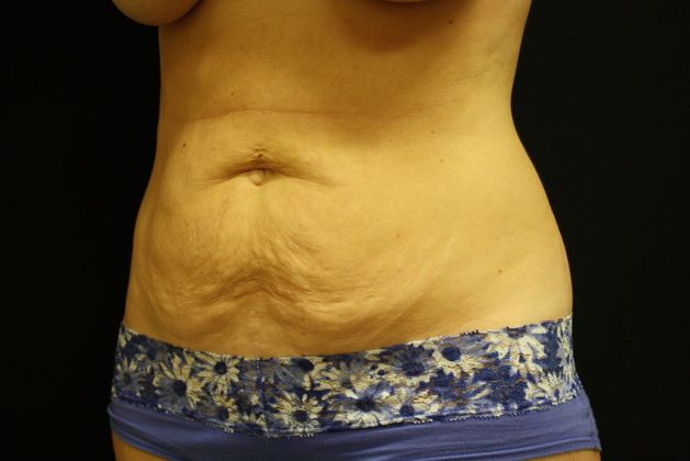 Tummy Tuck: Case 7 - Before