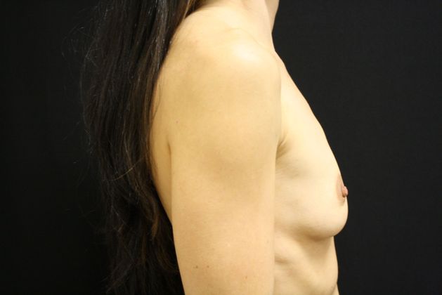 Breast Augmentation: Case 5 - Before