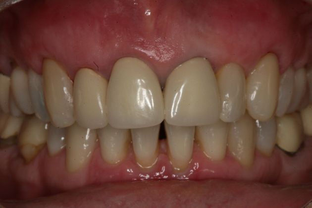 Gum graft: Gum Graft - After