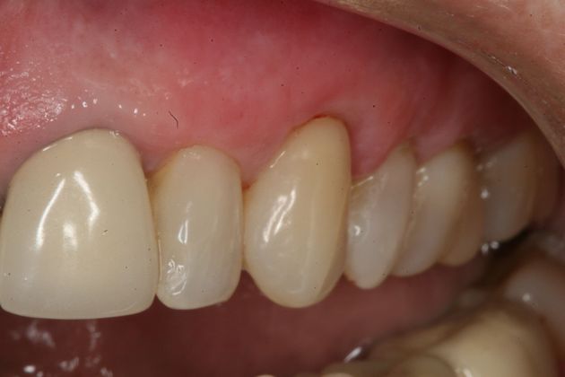 Gum graft: Gum Graft - After