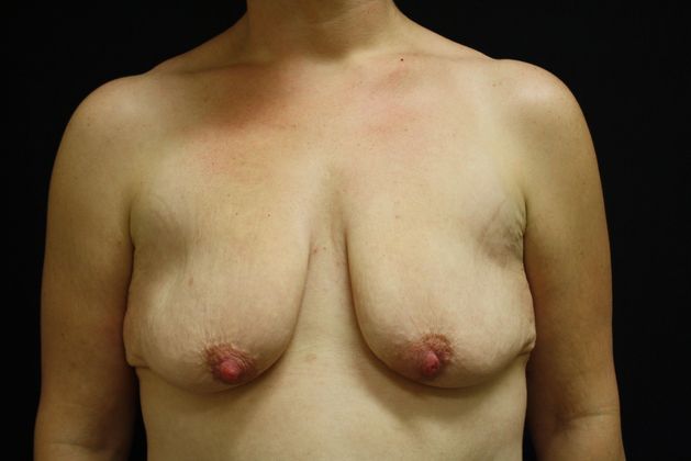 Breast Lift/Breast Lift Augmentation Case 2 - Before
