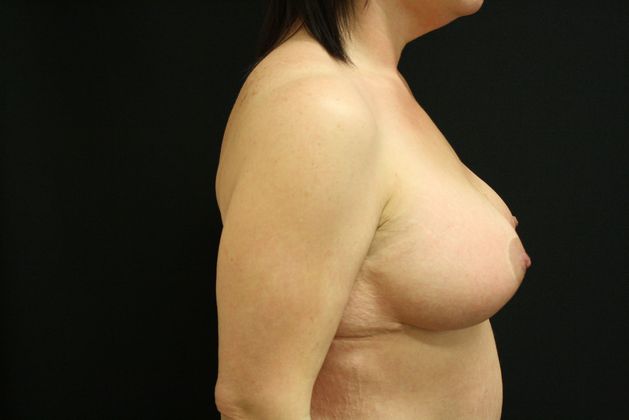 Breast Lift/Breast Lift Augmentation: Case 2 - After
