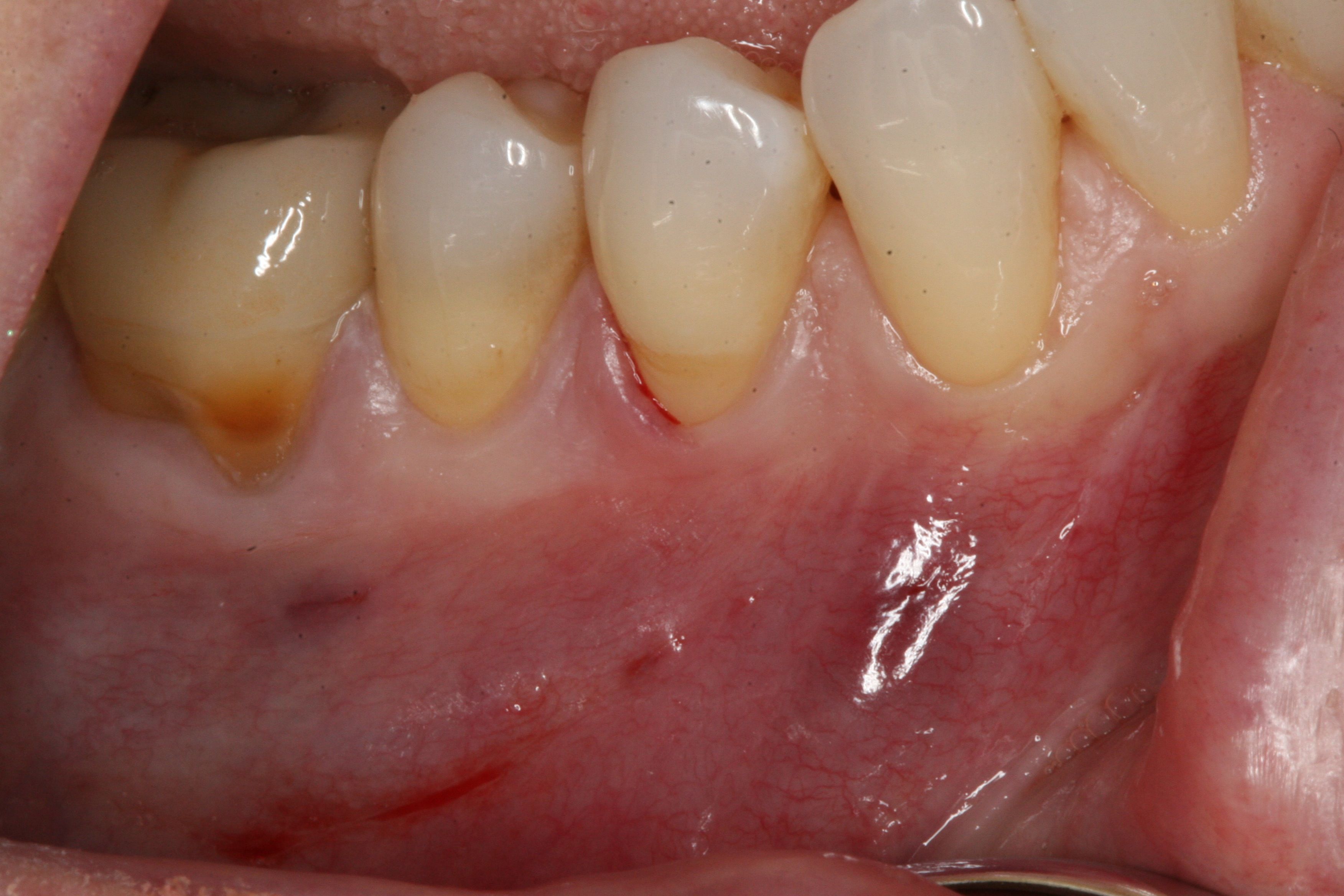 Alloderm Gum Graft - Gum graft - Before and After Gallery