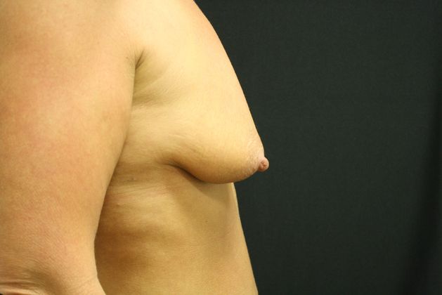 Breast Lift/Breast Lift Augmentation: Case 8 - Before