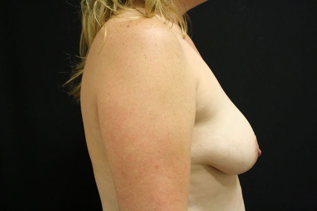 Breast Lift/Breast Lift Augmentation: Case 9