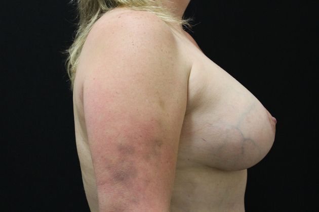 Breast Lift/Breast Lift Augmentation: Case 9