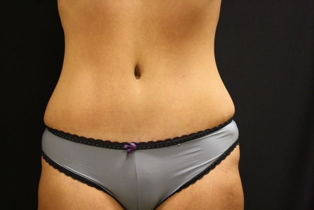 Tummy Tuck Case 8 - After