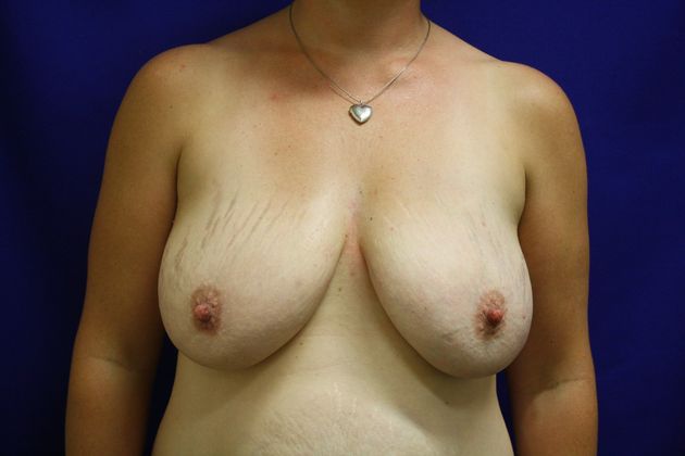 Breast Lift/Breast Lift Augmentation Case 10 - Before