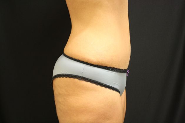 Tummy Tuck: Case 8 - After