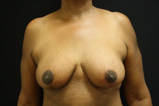 Breast Reduction Case 2 - After