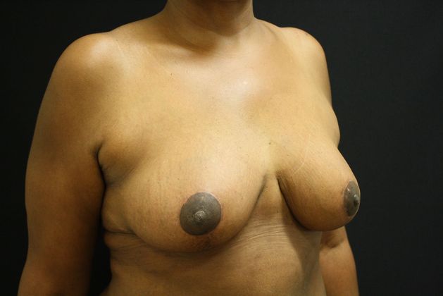 Breast Reduction: Case 2 - After