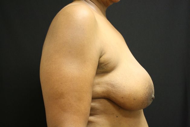 Breast Reduction: Case 2 - Before
