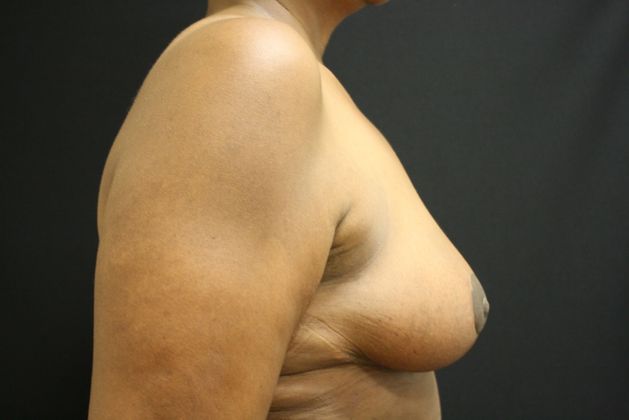 Breast Reduction: Case 2 - After